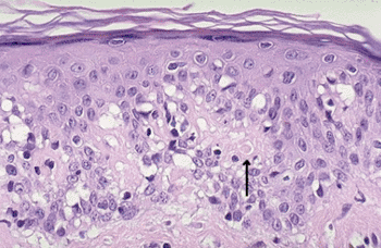 Image: Histopathology of graft-versus-host disease (Photo courtesy of Dr. Ed Friedlander).